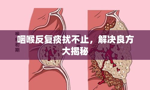咽喉反复痰扰不止，解决良方大揭秘